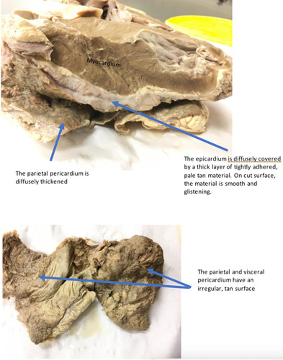 <p>At the time of necropsy, there was purulent fluid contained within the pericardial space. What is the significance of the clinical finding of purulent fluid in conjunction with the gross lesions you described?</p>