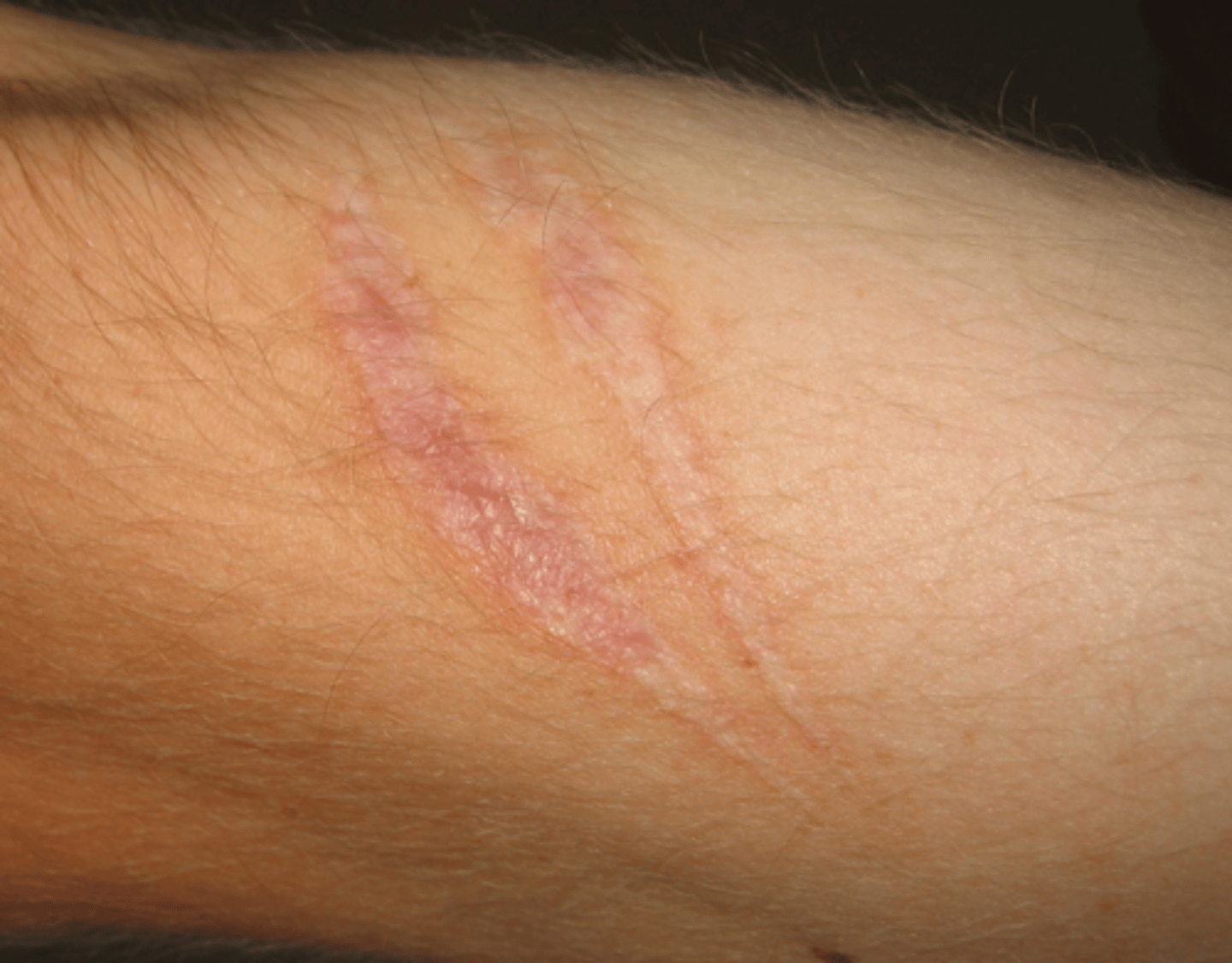 <p>A mark left on the skin or within body tissue where a wound, burn, or sore has not healed completely and fibrous connective tissue has developed.</p>