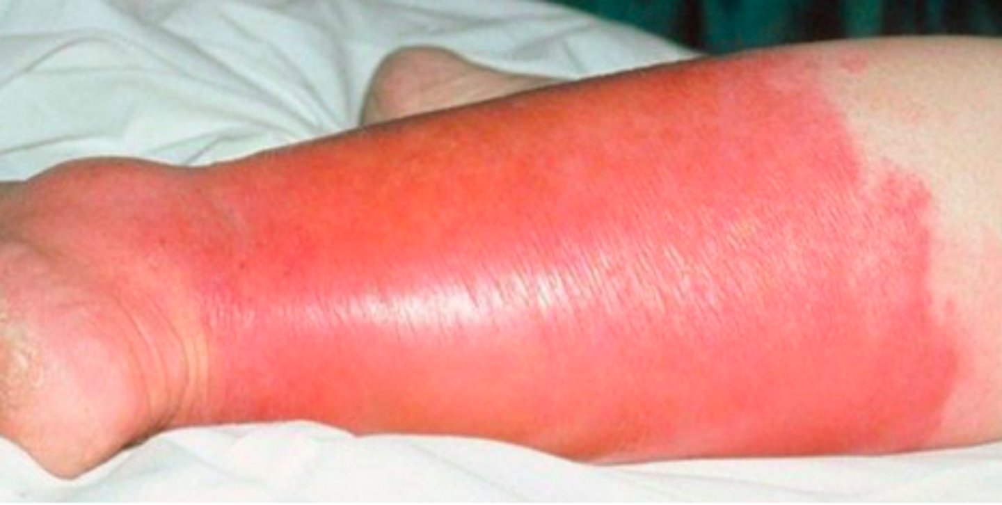 <p>Bacterial Skin Infections:</p><p>- inflammation &amp; infection of the <strong>upper layers of the skin (more superficial</strong>)</p><p>- caused by <strong>S. aureus and B. hemolytic streptococci in adults</strong> (<strong>HiB</strong> in children)</p><p>- red, hot, tender area of skin originating <strong>at the site of bacterial entry</strong></p><p>- may have a prodrome (malaise, anorexia, fever)</p><p>- erythema, <strong>warmth, &amp; edema</strong> of affected skin</p>