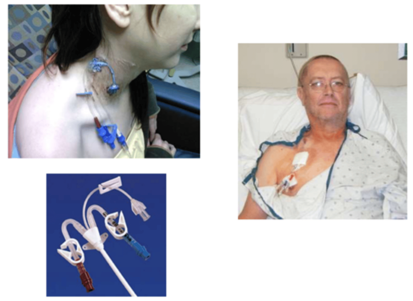 <p>Clinical Implications of Central (Venous) Line:</p><p>- No ______________________ on that UE</p><p>- Reduces risk of vein irritation</p><p>- ______________________ for placement → unlimited mobility</p><p>- ______________________ until cleared</p>