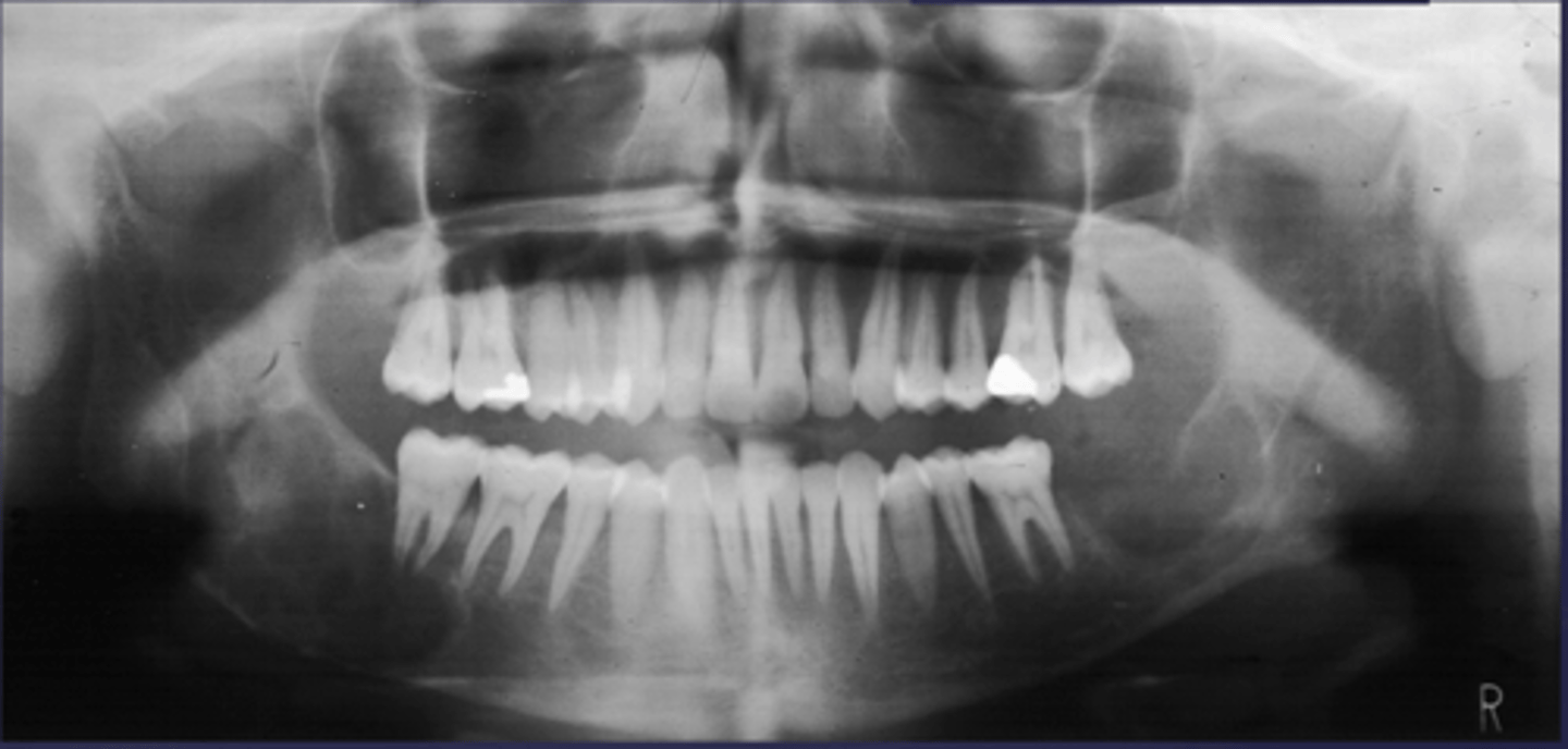 <p>What would be a differential diagnosis for this lesion?</p>