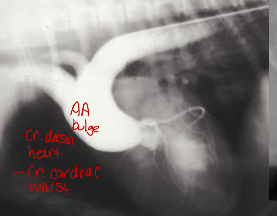 <p>-AA bulge</p><p>-increased cardiac waist</p><p>-left ventricular hypertrophy </p><p>-narrowing of aortic outflow tract</p><p>-post stenotic dilation of AA</p><p>± mitral regurg</p>