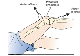 <p>skeletal traction </p>