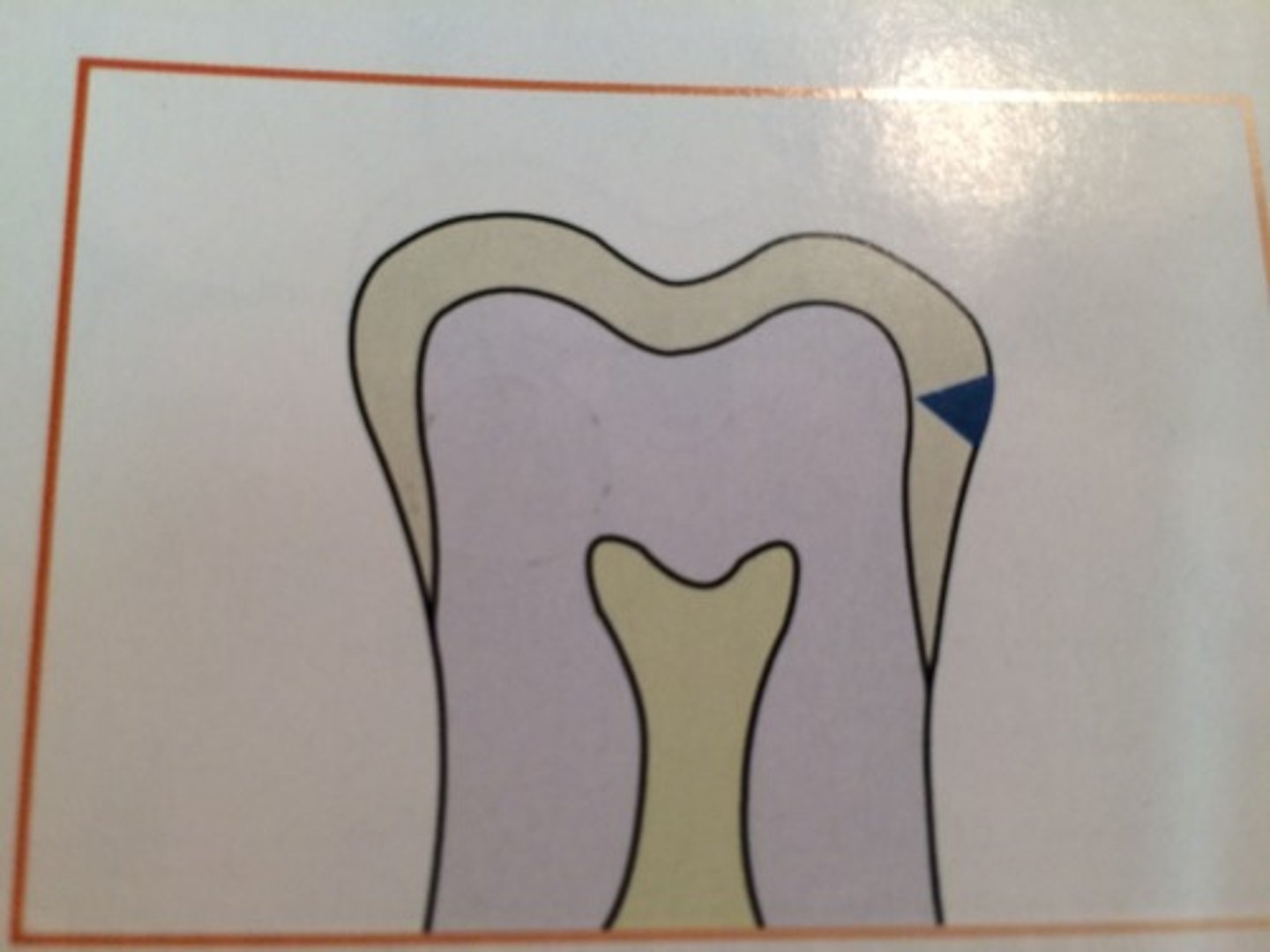 <p>extends more than half way through the enamel</p>