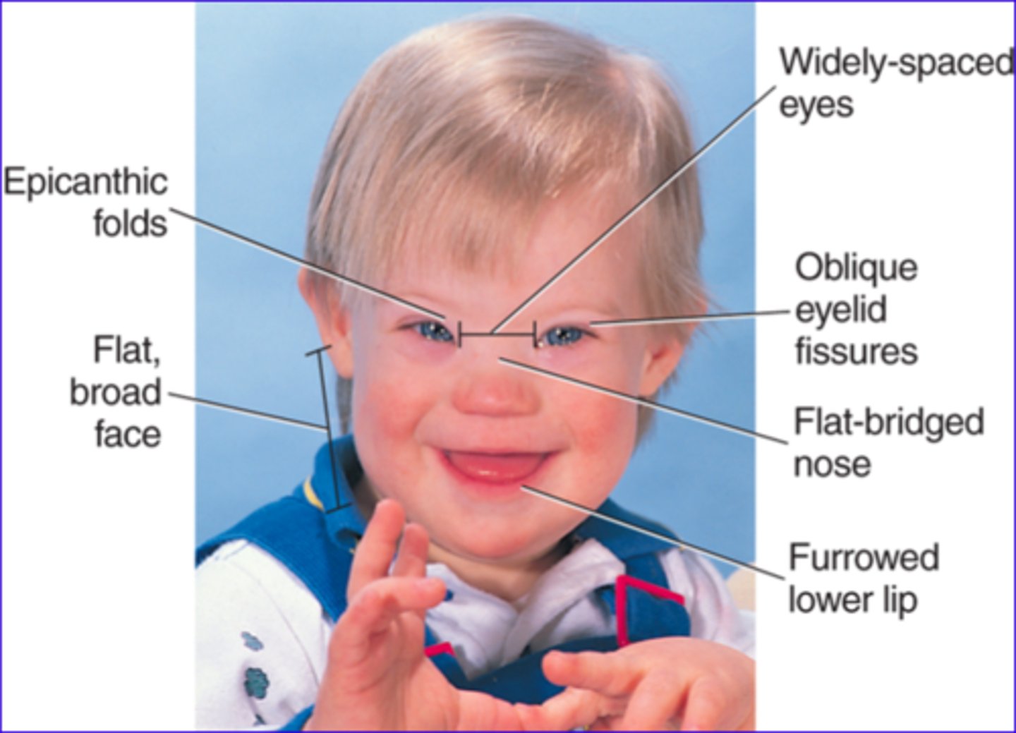 <p>Condition where there are three 21st chromosomes, leading to intellectual disability and physical features</p>