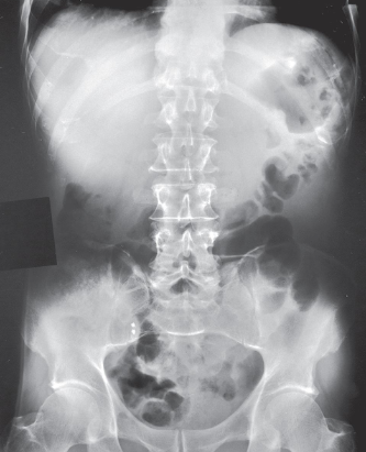 <ul><li><p>structures shown:</p><ul><li><p>inferior margin of liver</p></li><li><p>spleen</p></li><li><p>kidneys</p></li><li><p>psoas muscles</p></li><li><p>calcifications</p></li><li><p>evidence of tumor masses</p></li><li><p>size and shape of liver if upper abdomen and diaphragm included</p></li></ul></li><li><p>evaluation criteria:</p><ul><li><p>no motion</p></li><li><p>outlines of abdominal viscera</p></li><li><p>abdominal region including ppubic symphysis or diaphragm</p></li><li><p>vertebral cloumn centered</p></li><li><p>psoas muscles, lower margin of liver, and kidney margins</p></li><li><p>no rotation</p><ul><li><p>symmetric appearance of vertebral column and iliac wings</p></li></ul></li></ul></li></ul><p></p>