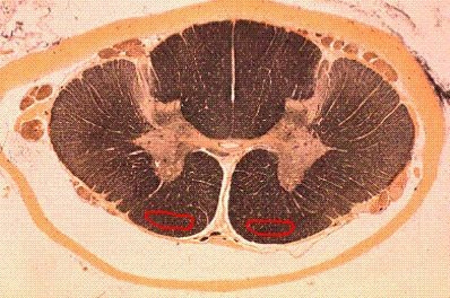 <p>• arises in the medial vestibular nucleus</p><p>• terminates on LMN circuit neurons of cervical and upper thoracic</p><p>levels</p><p>o controlling the neck muscles (tandem with corticobulbar</p><p>tract)</p><p>o stabilizing the head</p><p>o coordinating head movements with eye movements</p>
