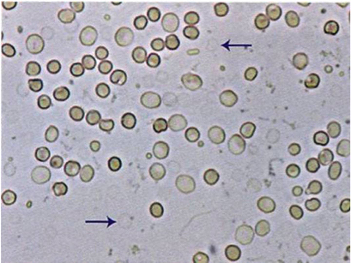 <p>RBCs in hypotonic urine</p>