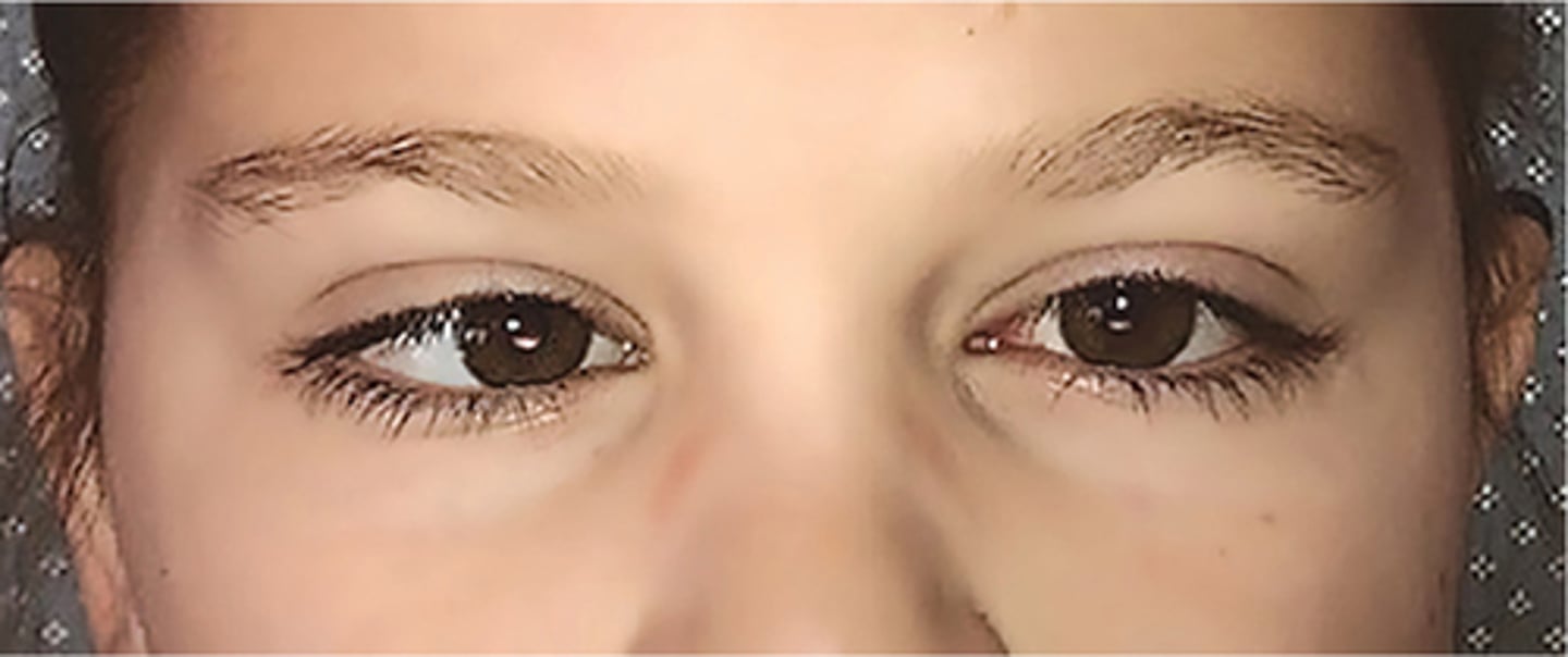 <p>The physical examination of the child with strabismus may reveal (Figure 20.4):</p><p>■Visible misalignment of eyes</p><p>■Asymmetric Hirschberg test</p><p>■Asymmetric Bruckner test</p><p>■Strabismus manifested during the cover test</p><p>■Latent strabismus noted on cover/uncover test</p><p>■Abnormal eye movement upon examination</p><p>■Poor vision—inability to focus with both eyes simultaneously but able to focus with either eye individually</p><p>■Torticollis</p>