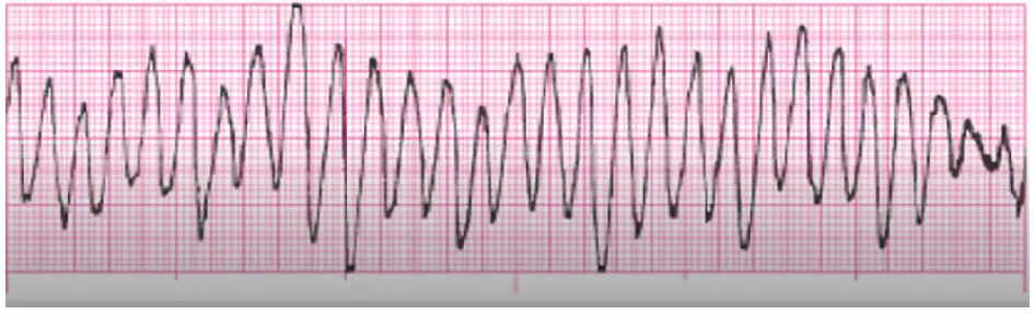 <p>treat cause (low Mg++/K+), amiodarone can cause</p><p>Mg++ bolus to slow HR</p><p>cardioversion</p>