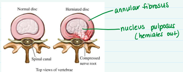 <p>Nucleus pulposus</p>
