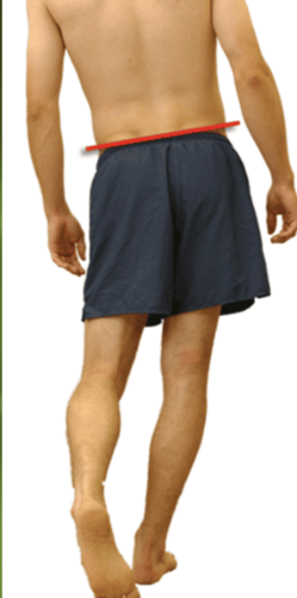<p>Excess <strong><u>trunk lean</u></strong> (<strong>T</strong>rende<strong>l</strong>enberg)</p><p>Bilateral weakness - waddling gait</p>