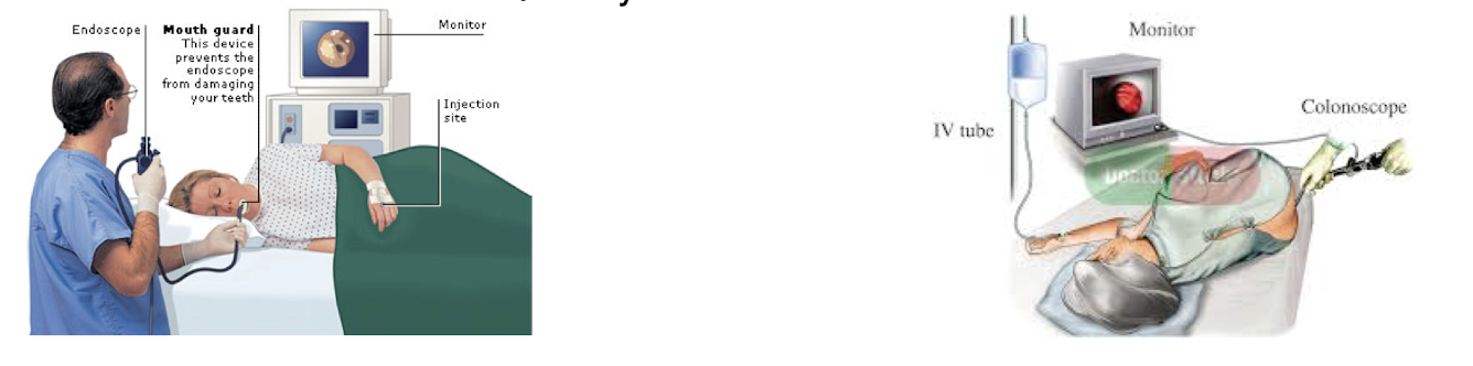 <p>Risks: sedation and perforation</p><p>Benefits Endoscopy is becoming preferential</p><ul><li><p>direct referrals to GI</p></li><li><p>safer</p></li><li><p>biopsy capability</p></li></ul><p></p>