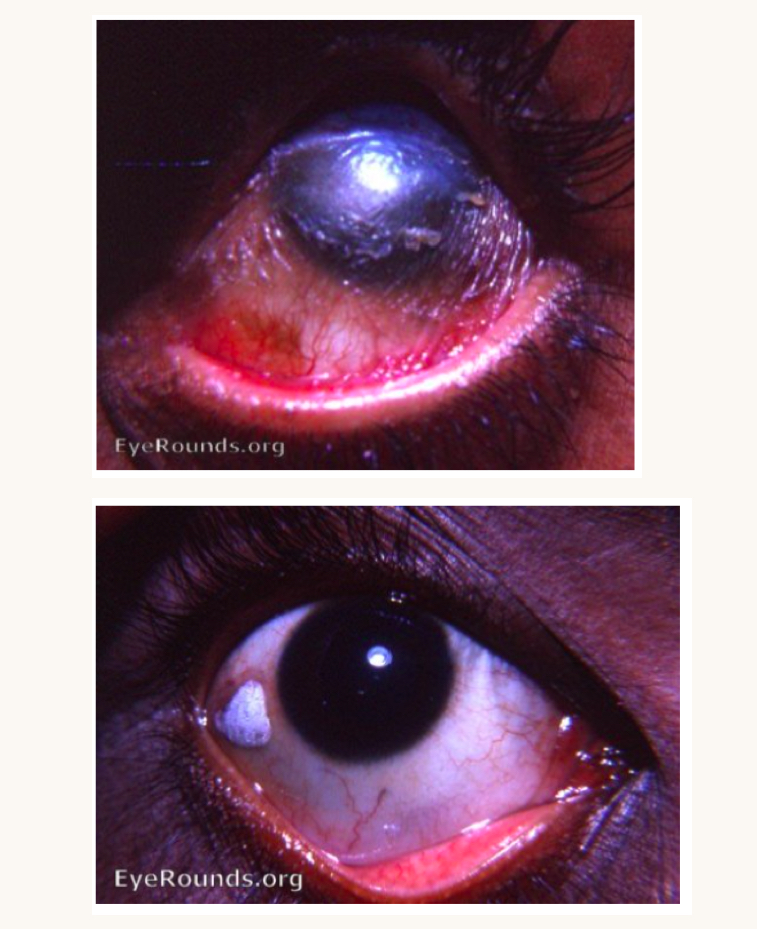 <p>what is this condition and what vitamins is this person likely deficient in?</p>