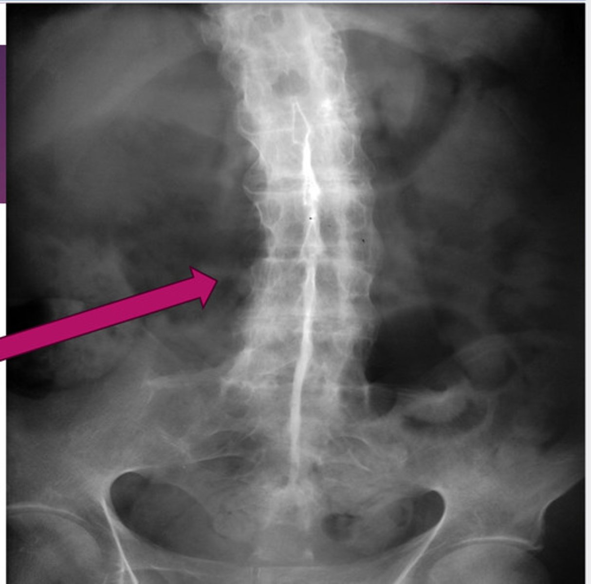 <p>ankylosing spondylitis; no spaces b/w vertebrae</p>
