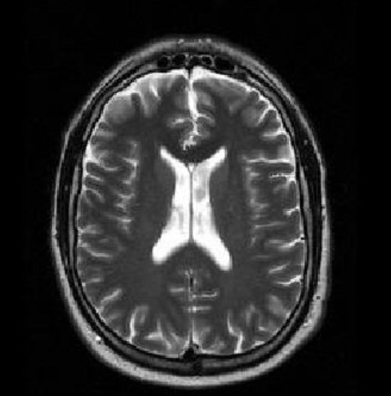 <p>Axial spin recovery time (brightest) CSF/water - grey matter - white matter - fat</p>