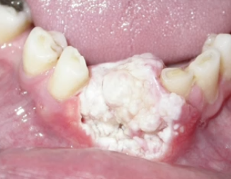 <p>What is the treatment for Verrucous Carcinoma?</p>