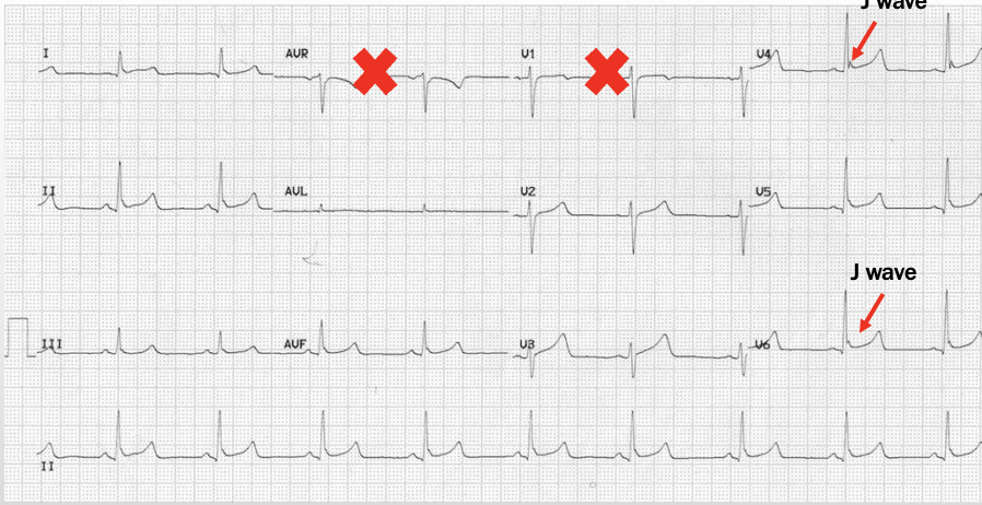 <p>global concave ST elevation, terminal QRS notching (J wave, Osborn wave), large T waves, no reciprocal ST depression (outside of aVR and V1)</p>