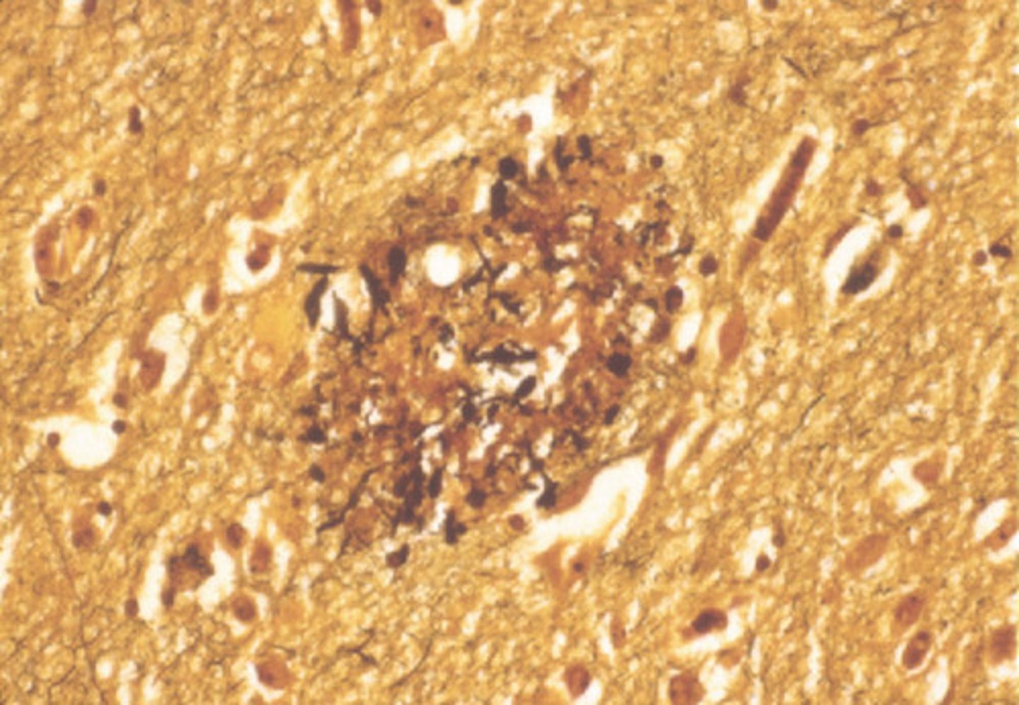<p>β-amyloid protein</p>