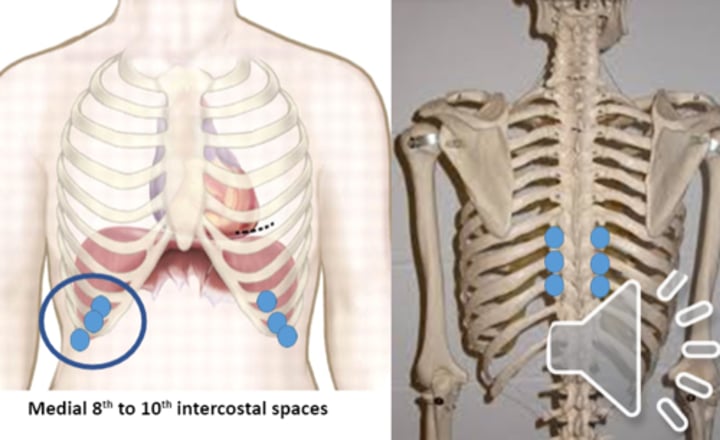 <p>anterior point: medial 8th-10th intercostal space<br>posterior point: T8-T10 transverse processes</p>