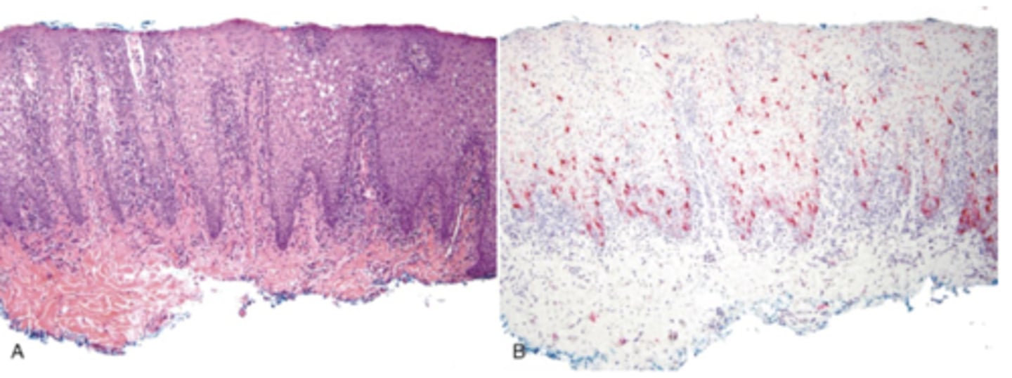 <p>What pigmented lesion has these histopathologic features?</p><p>- Dendritic melanocytes throughout epithelium</p><p>- Thickened epithelium</p><p>- Increase in basal layer melanocytes</p><p>- Spongiosis and mild acanthosis</p>