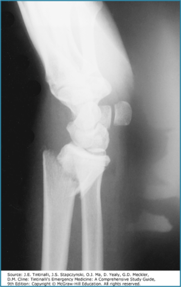 <p>FOOSH with flexed wrist</p><p>pain of distal radius/wrist</p><p>may be extra-articular, intraarticular or part of fracture-dislocation of wrist</p><p>radiographic findings: dorsal fracture of distal radius with hand and wrist displaced volarly</p>