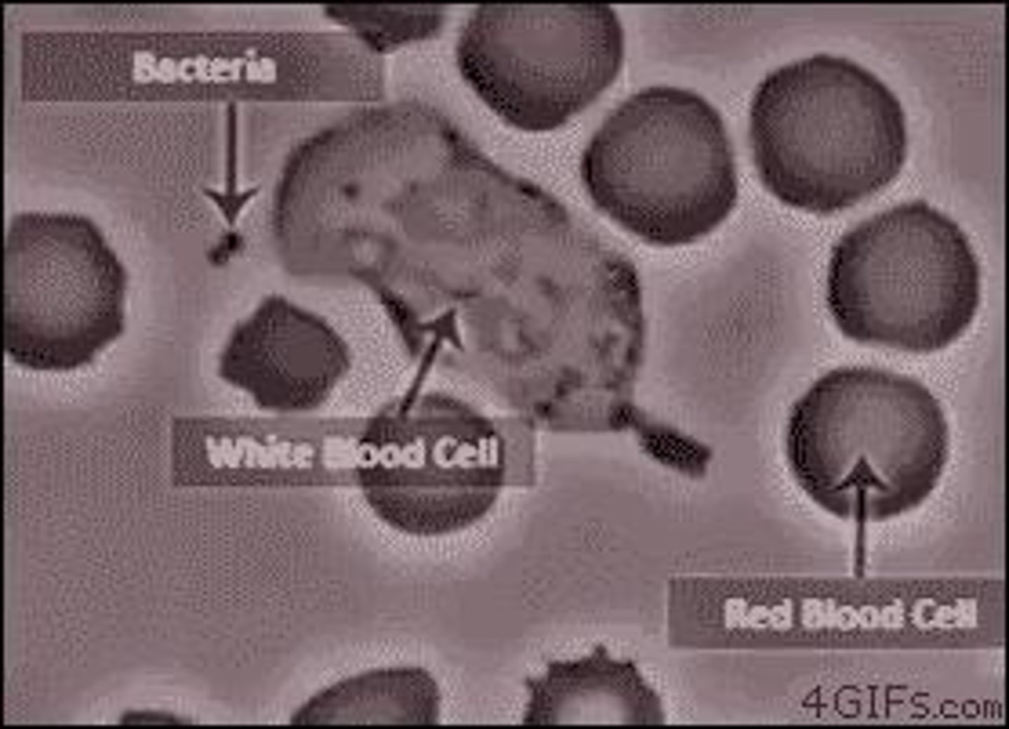 <p>Cause: Autoimmune attack on synovial joints. ECM Destruction: Chronic inflammation leads to excessive MMP activity, breaking down collagen, fibronectin, and hyaluronic acid in the joint ECM.</p>