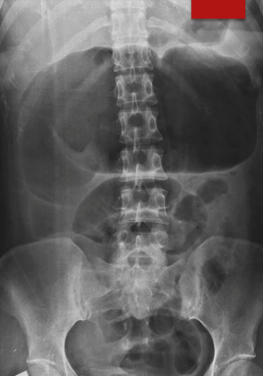 <p>What occurs due to non-obstructive, severe colon dilation &gt;6cm with UC and CD as #1 causes?</p>