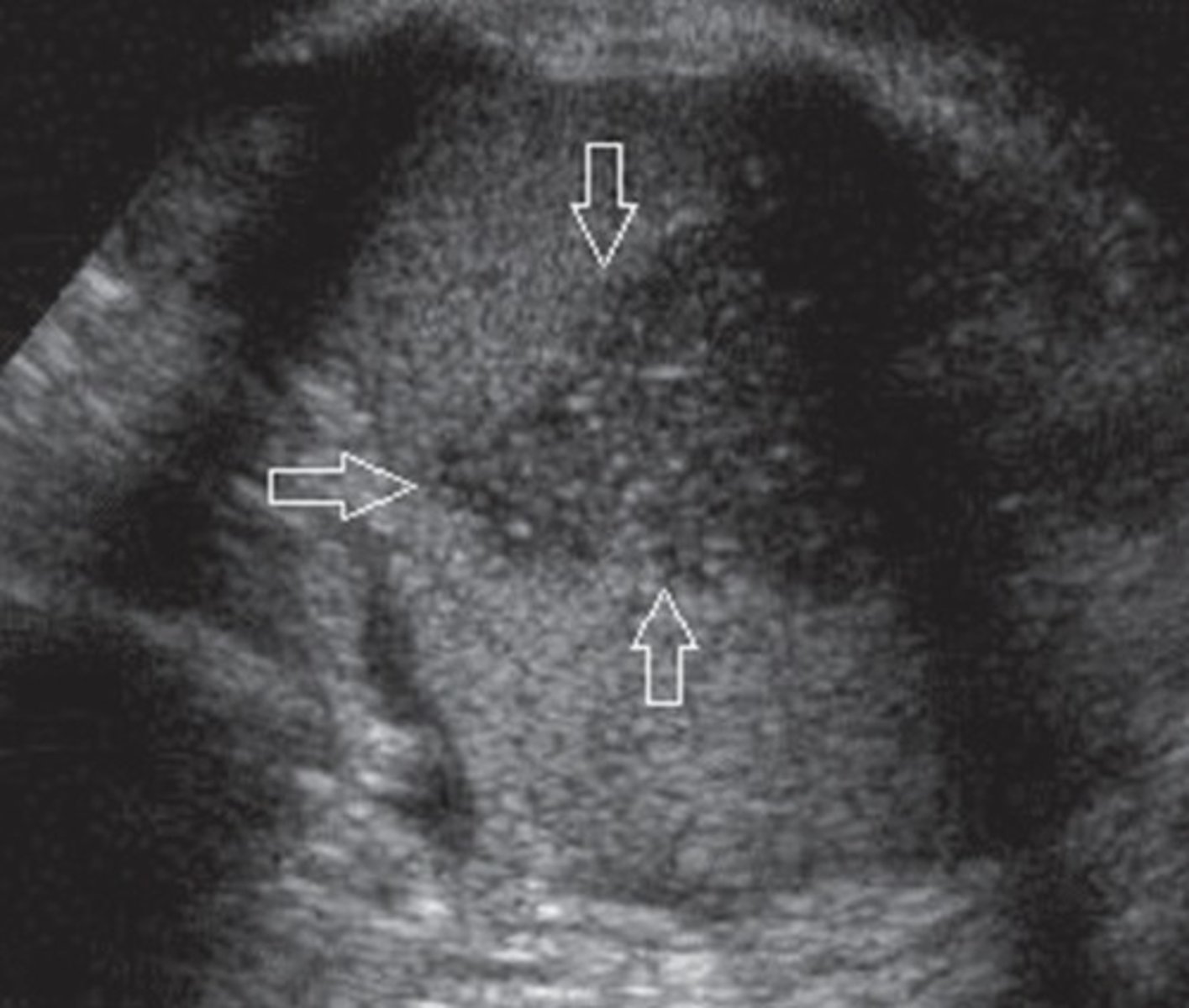 <p>Well-demarcated</p><p>Wedge-shaped</p><p>Hypoechoic (echogenicity increases with age of infarction)</p>