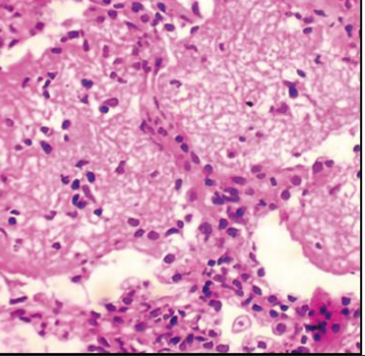 <p>what type of exudate is depicted microscopically?</p>