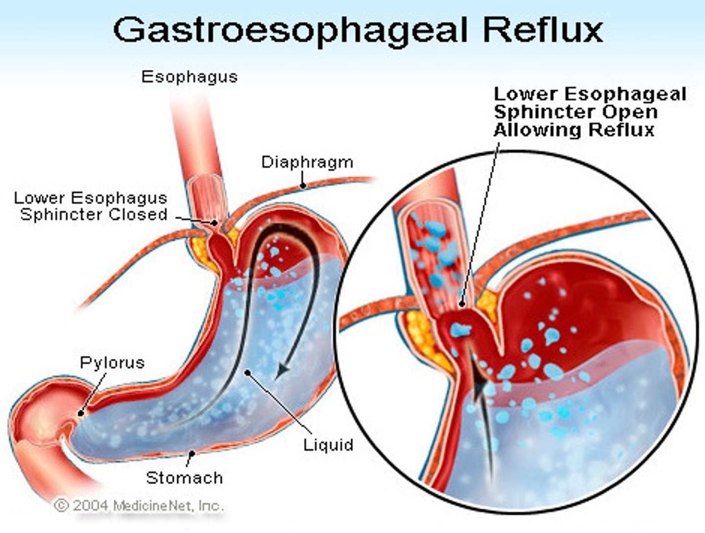 <p>gastroesophageal reflux disease</p><p>aka heartburn and acid indigestion</p><p>lower esophageal (cardiac) sphincter relaxes inappropriately and allows stomach's contents (acid) to flow up to the esophagus</p>