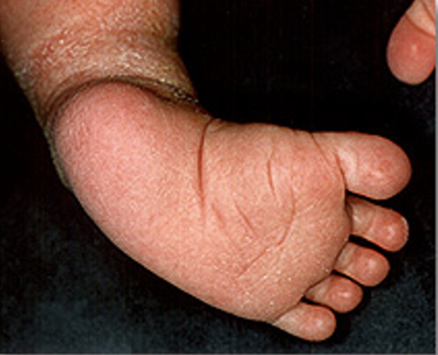 <p>•Small foot</p><p>•Shortened Achilles tendon</p><p>•Underdeveloped calf muscle</p><p>•Empty heel bed</p><p>•Transverse plantar crease (image)</p><p>•Normal leg lengths</p>