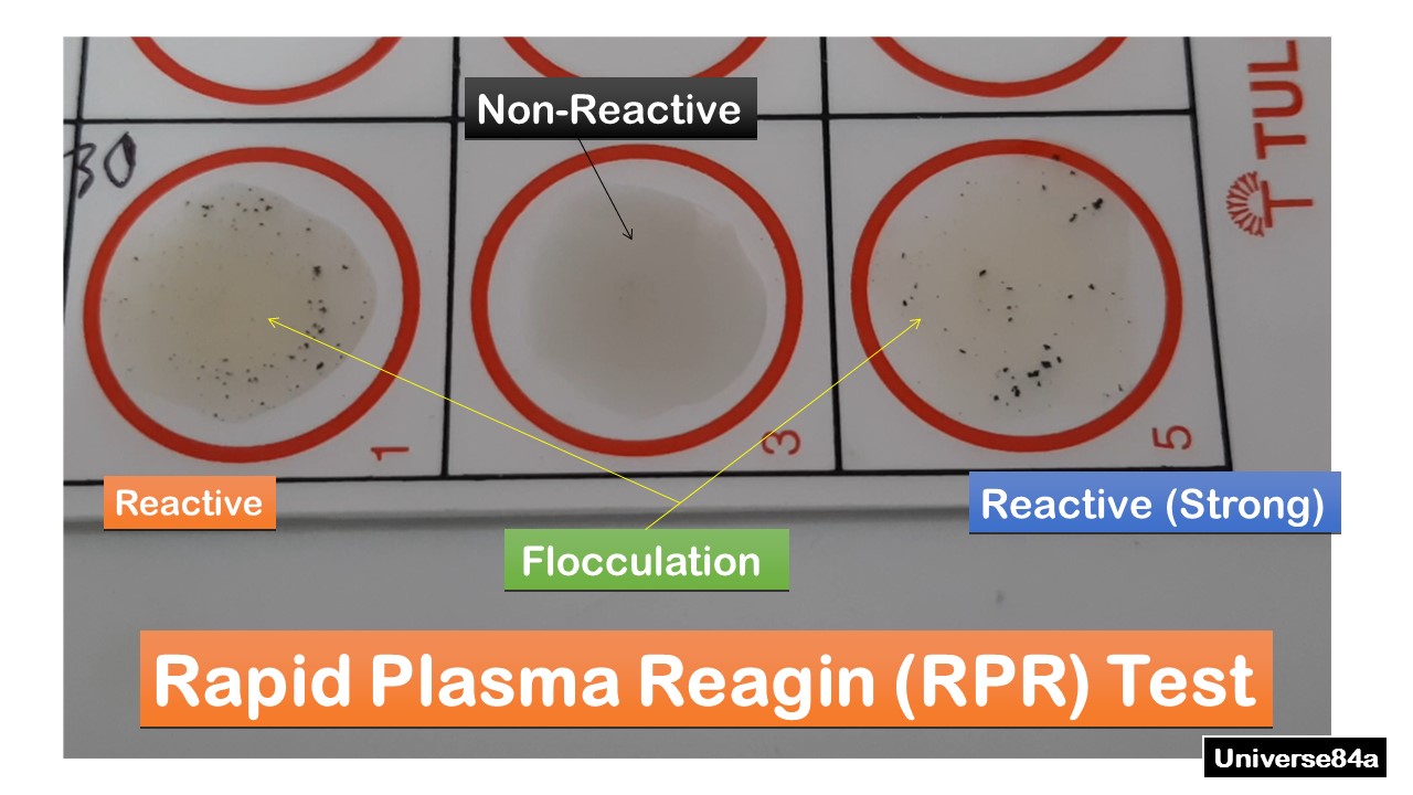 <p>Non-treponemal testing</p><p>Cardiolipin, chlone chloride, EDTA, and charcoal</p><p>Swirl and look for tail</p><p><strong><u>Plasma or serum no heat inactivation</u></strong></p><p>CANNOT USE CSF</p>