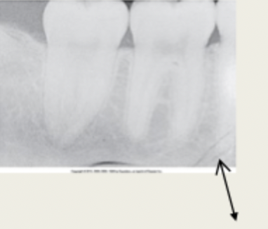 <p>What causes<strong> fingernail artifact</strong>? </p>