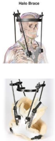 <p>Complications associated with halo brace?</p>