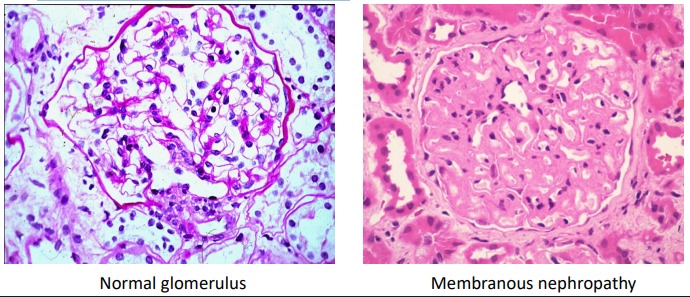 <p>Compare the glomeruli in these light microscopy images:</p><ul><li><p>Thickening of glomerular basement membrane</p></li><li><p>Number of cells unchanged</p></li></ul><p></p>