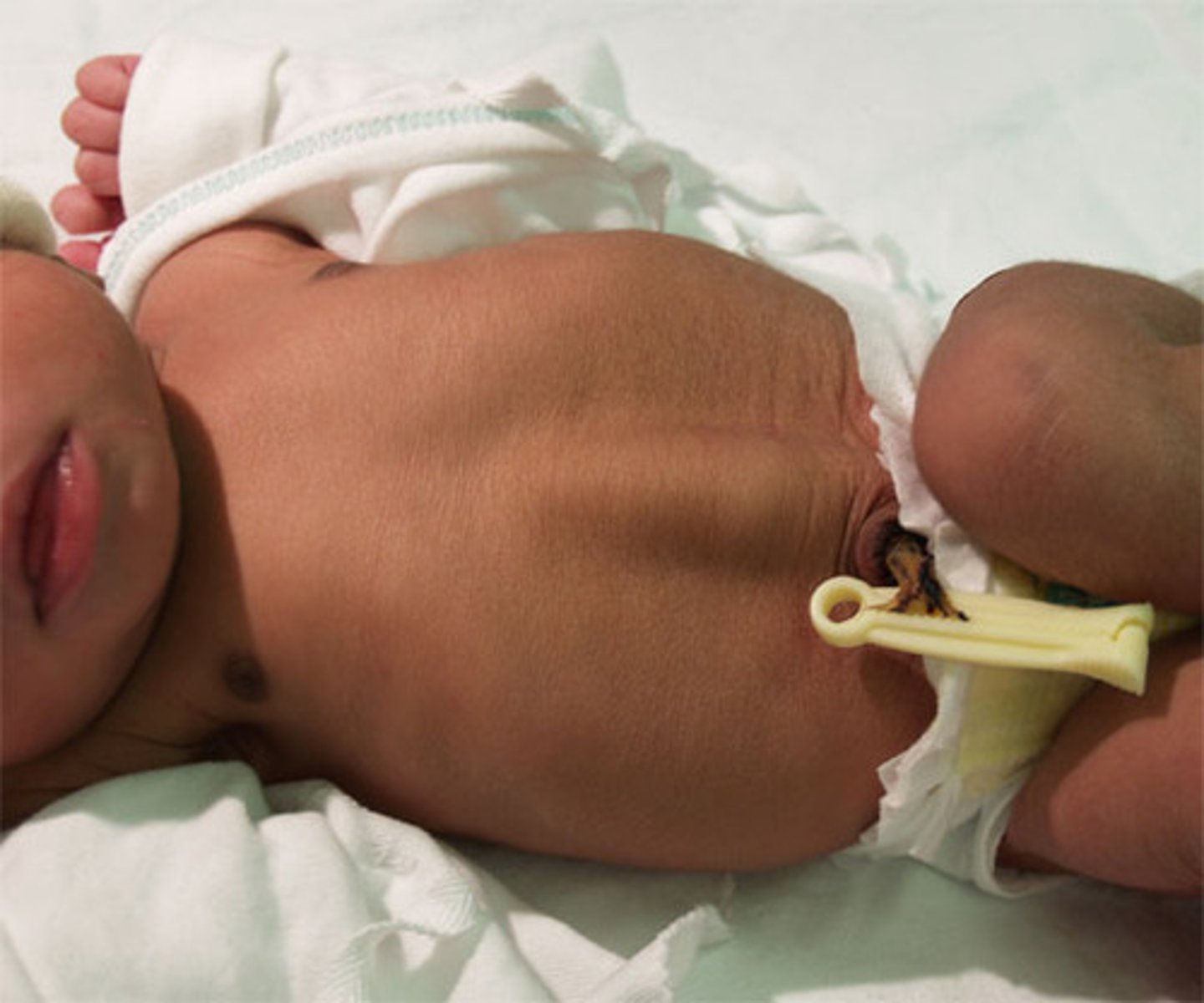 <p>midline longitudinal ridge in the abdomen, a separation of abdominal rectus muscles</p>