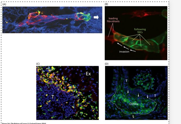 <ul><li><p class="Paragraph WhiteSpaceCollapse SCXP148896080 BCX0" style="text-align: left"><span>(A) Cancer cells release proteases which remodel the ECM (degrade proteins in the BM)​</span></p></li><li><p class="Paragraph WhiteSpaceCollapse SCXP148896080 BCX0" style="text-align: left"><span>ECM = blue​</span></p></li><li><p class="Paragraph WhiteSpaceCollapse SCXP148896080 BCX0" style="text-align: left"><span>Black indicates areas where the ECM has been degraded​</span></p></li><li><p class="Paragraph WhiteSpaceCollapse SCXP148896080 BCX0" style="text-align: left"><span>Red = adherens junctions (E-cadherin) that enable cancer cells to adhere to one another​</span></p></li><li><p class="Paragraph WhiteSpaceCollapse SCXP148896080 BCX0" style="text-align: left"><span>White arrow = leading edge where cancer cells are expressing integrins (green) which allow them to attach to the still intact ECM​</span></p></li><li><p class="Paragraph WhiteSpaceCollapse SCXP148896080 BCX0" style="text-align: left"><span>Cancer cells can make and secrete their own proteases or induce stromal cells to release them​</span></p></li><li><p class="Paragraph WhiteSpaceCollapse SCXP148896080 BCX0" style="text-align: left"><span>(B) cancer cells following stromal cells (fibroblasts) making a path for them​</span></p></li><li><p class="Paragraph WhiteSpaceCollapse SCXP148896080 BCX0" style="text-align: left"><span>(C) Cancer cells recruit macrophages (green) and induce them to release proteases​</span></p></li><li><p class="Paragraph WhiteSpaceCollapse SCXP148896080 BCX0" style="text-align: left"><span>(D) mouse model of intestinal carcinogenesis – recruitment of immature myeloid cells (CD34+) that will secrete proteases​</span></p></li></ul><p class="Paragraph WhiteSpaceCollapse SCXP148896080 BCX0" style="text-align: left"></p><p class="Paragraph WhiteSpaceCollapse SCXP148896080 BCX0" style="text-align: left"><span><strong>The epithelial-mesenchymal transition (EMT)</strong>​</span></p><ul><li><p class="Paragraph WhiteSpaceCollapse SCXP143967803 BCX0" style="text-align: left"><span>To acquire motility and invasiveness the carcinoma cells must shed their epithelial phenotype and undergo a drastic alteration <strong>--- EMT</strong>​</span></p></li><li><p class="Paragraph WhiteSpaceCollapse SCXP143967803 BCX0" style="text-align: left"><span>This requires a transcriptional program more characteristic of mesenchymal cells – involves coordinated expression of hundreds of genes and the production of new proteins​</span></p></li><li><p class="Paragraph WhiteSpaceCollapse SCXP143967803 BCX0" style="text-align: left"><span>This does happen normally during developmental morphogenesis and during wound healing – carcinoma cells tap into these cellular programs – key feature of metastasis​</span></p></li></ul><p class="Paragraph WhiteSpaceCollapse SCXP148896080 BCX0" style="text-align: left"><span>​</span></p>