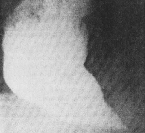 <p>What esophageal disorder is this?</p>
