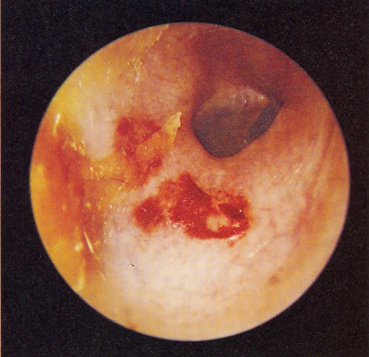 <p><u>disordered otoscopy: canal</u></p><p>abrasion of canal</p>