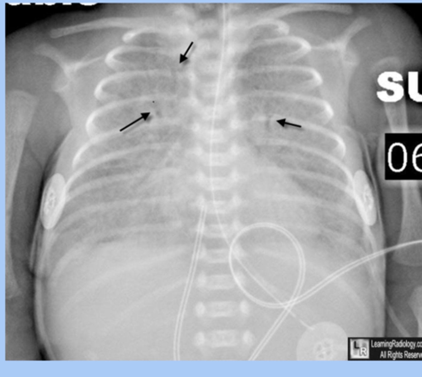<p>-bilateral atelectasis with ground glass appearance</p>