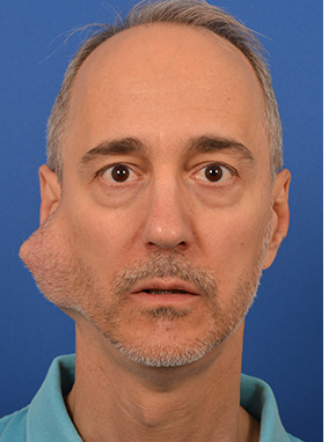 <p>typically is a painless non-ulcerative mass in front of ear or in neck</p><ul><li><p>facial nerve paralysis, pain, ulceration, dysphagia, and difficulty articulating speech may occur as well</p></li></ul><p></p>