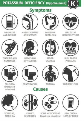 <p>Hypokalemia (not enough potassium)</p><p>Signs/symptoms: Arrhythmias. Muscle weakness → paralysis (lower extremities) U waves and flattened T waves {EKG}</p><p>Causes: Increased renal loss (diuretics). Increased Gi losses (vomiting/diarrhea)</p><p>Increased K entry into cells. Hypomagnesemia.<mark data-color="#NaNNaNNaN" style="background-color: #NaNNaNNaN; color: inherit"> Cannot correct K until Mg is corrected.</mark></p><p></p>