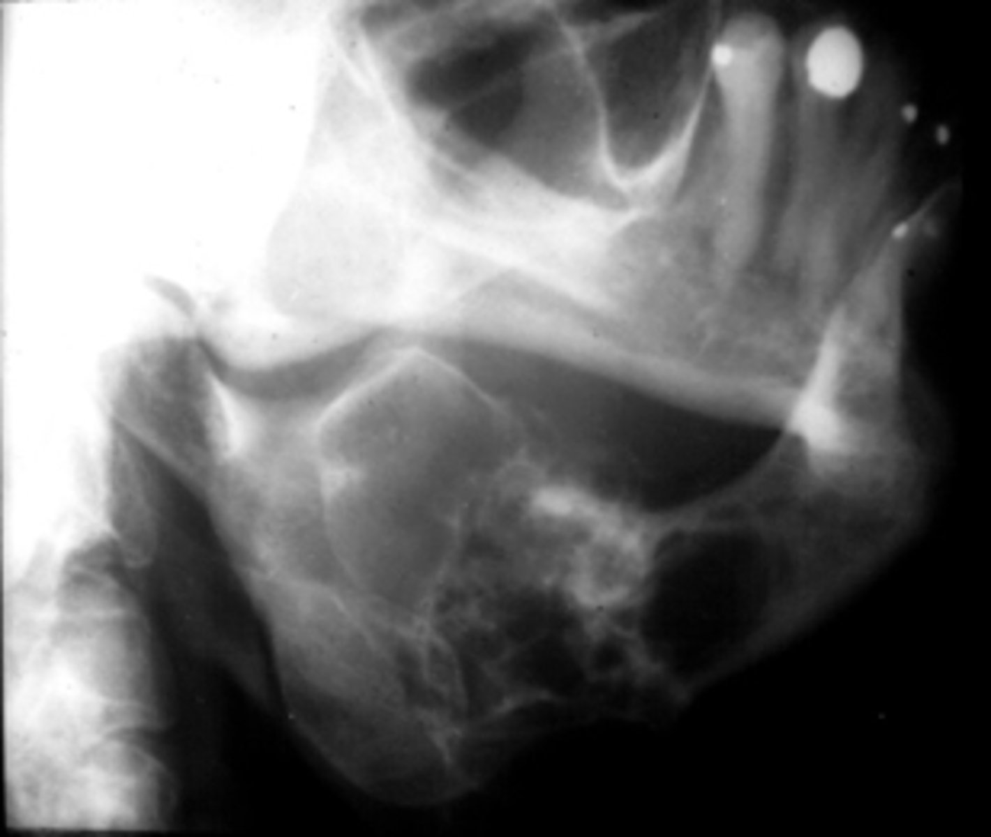<p>15 y/o patient presents with a lesion with mix of well and ill-defined margins, radiolucent, multilocular with very thin straight and curved septae. Lesion in expansile and can cause tooth displacement. Has "tennis -racket" pattern. What is the diagnosis?</p>