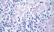 <ul><li><p>normal tissue cells still present </p></li><li><p>lots of undyed areas due to tissue organisation still intact </p></li><li><p>shape of mast cells are uniform and round </p></li></ul><p></p>