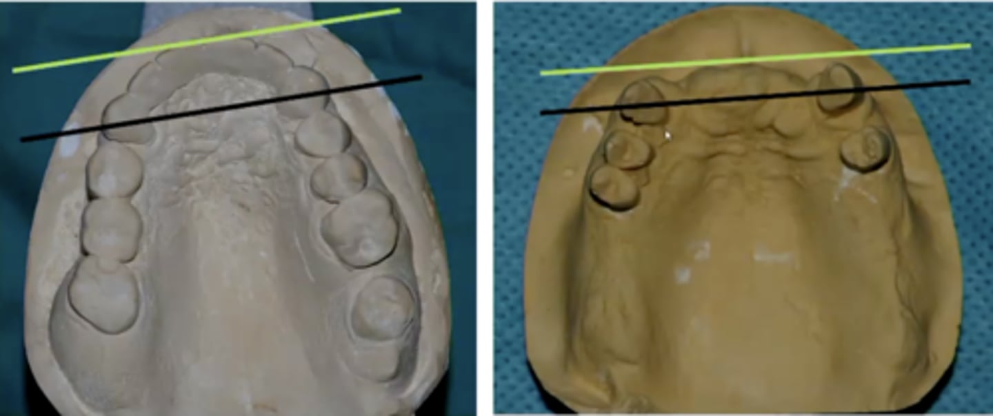 <p>Patients needing a 6-unit anterior FPD with a _________ arch form will have a longer cantilever arm from the canine line</p><p>a) taper or oval arch</p><p>b) square arch</p>