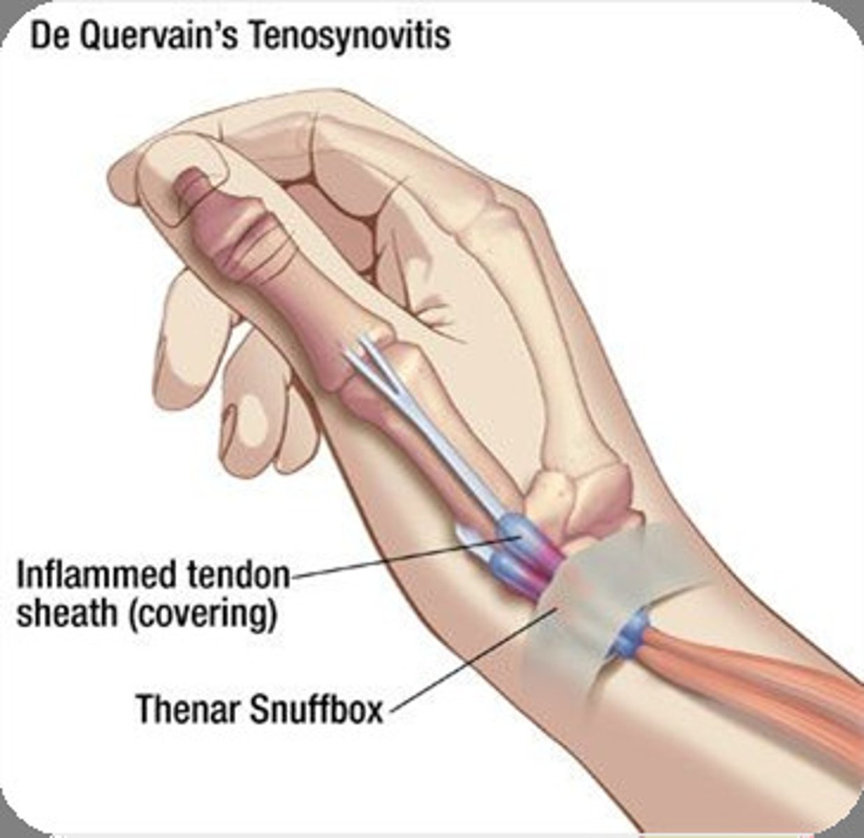 <p>de Quervain's tenosynovitis</p>