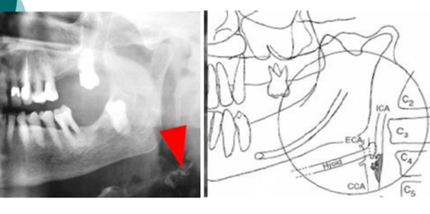 <p>Common carotid artery</p>