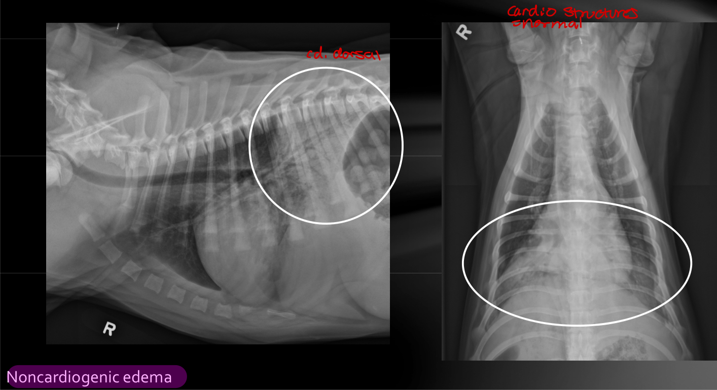 noncardiogenic edema