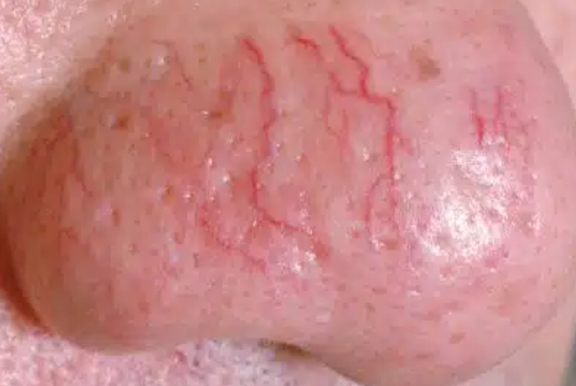 <p>Telangiectasia</p>